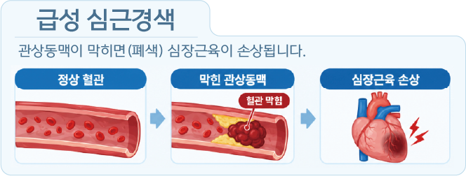 정상 혈관이 혈전으로 막혀 심장근육이 손상되는 급성 심근경색 설명